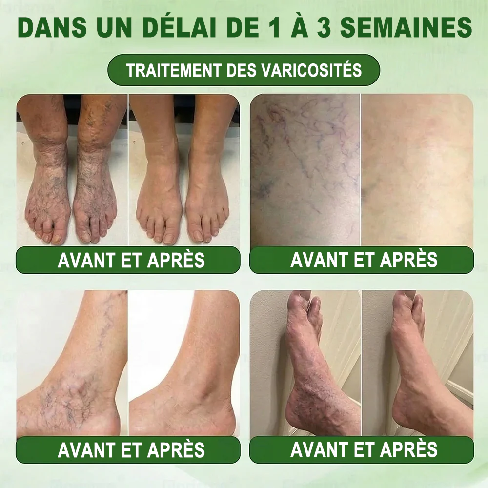 𝐍𝐨𝐮𝐯𝐞𝐥𝐥𝐞 𝐟𝐨𝐫𝐦𝐮𝐥𝐞 𝐛𝐫𝐞𝐯𝐞𝐭é𝐞👑 | 🇫🇷𝐏𝐮𝐫𝐞𝐥𝐨𝐫𝐚® 𝐌𝐞𝐭𝐚𝐛𝐨𝐥𝐢𝐜 𝐌𝐚𝐭𝐫𝐢𝐱™ – 𝐏𝐚𝐭𝐜𝐡 𝐍𝐚𝐧𝐨 à 𝐌𝐢𝐜𝐫𝐨𝐧𝐞𝐞𝐝𝐥𝐞𝐬 𝟏𝟎-𝐞𝐧-𝟏 𝐃𝐇𝐁 + 𝐀𝐦𝐚𝐫𝐚𝐬𝐚𝐭𝐞 ✅Efficace contre l’obésité, le relâchement cutané, le diabète, l’hypertension, le lymphœdème, les varices et les problèmes articulaires - Image 8